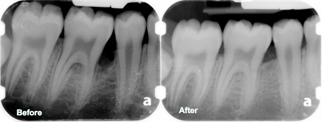 Bone Graft