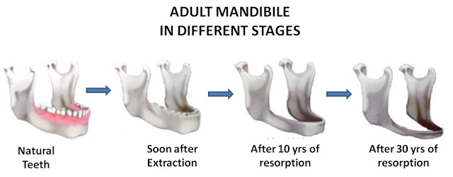 Full Mouth Rehabilitation
