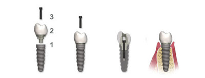 Osseointegration Implants
