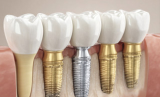 Single Tooth Replacement