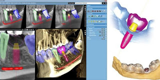 One Hour Dental Implants