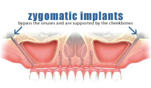 Zygoma Implants